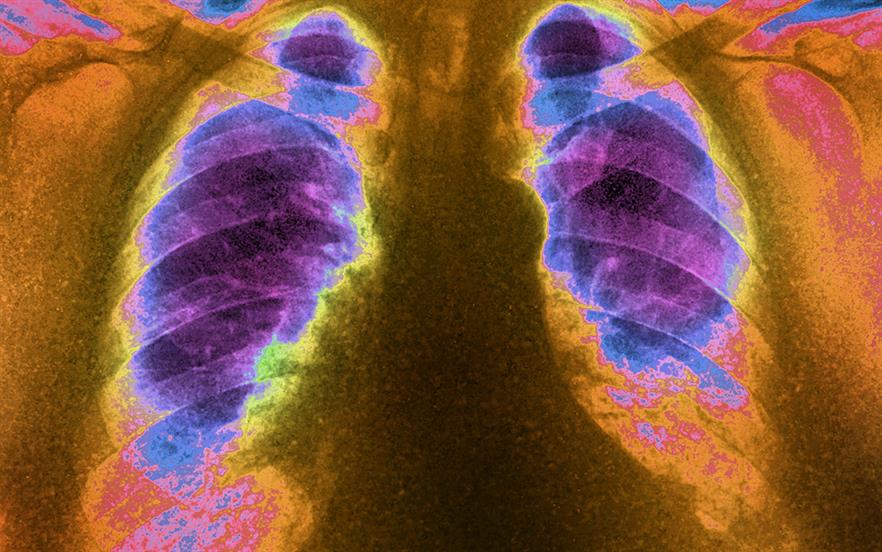 Patients receiving tofacitinib for any indication should be monitored for signs and symptoms of pulmonary embolism. | James Cavallini/Science Source/SCIENCE PHOTO LIBRARY 
