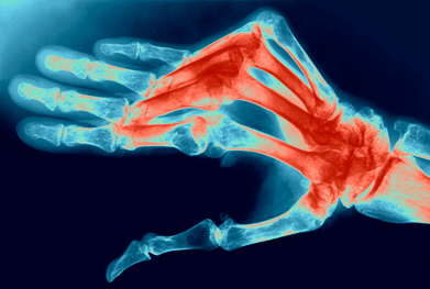 Other JAK inhibitors are also in development for rheumatoid arthritis | SCIENCE PHOTO LIBRARY