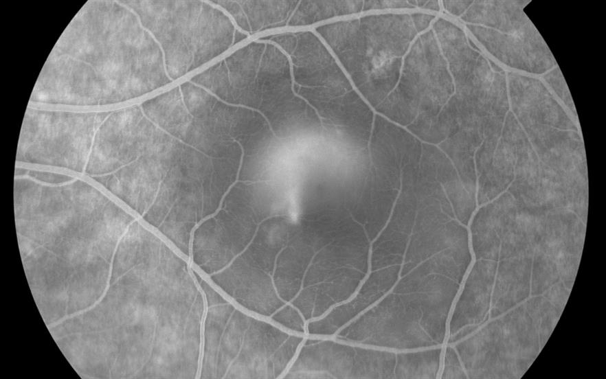 CSCR typically affects one eye only and can cause vision to be blurry and distorted. | Paul Whitten/SCIENCE PHOTO LIBRARY