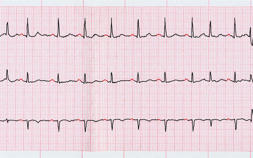 Print-out of an electrocardiogram (ECG) showing paroxsyms of atrial fibrillation.