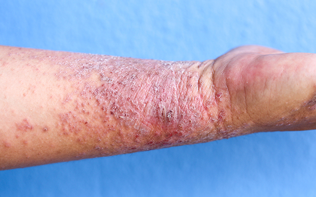 Atopic dermatitis can have a serious impact on patients' quality of life, both physically and mentally. | iStock/Sinhyu
