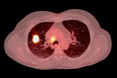 Food should not be consumed for at least 3 hours before and at least 1 hour after taking Giotrif (afatinib) for NSCLC (pictured) | SCIENCE PHOTO LIBRARY