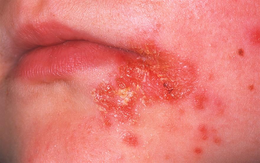 Impetigo is highly infectious, and treatment should be offered to limit the spread of infection, hasten recovery and limit deterioration. | DR P. MARAZZI/SCIENCE PHOTO LIBRARY