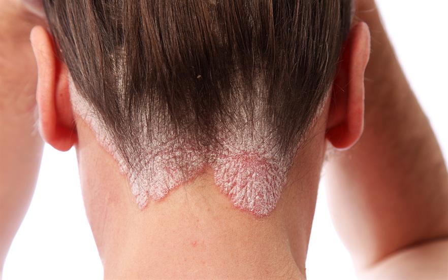 how to treat psoriasis nhs