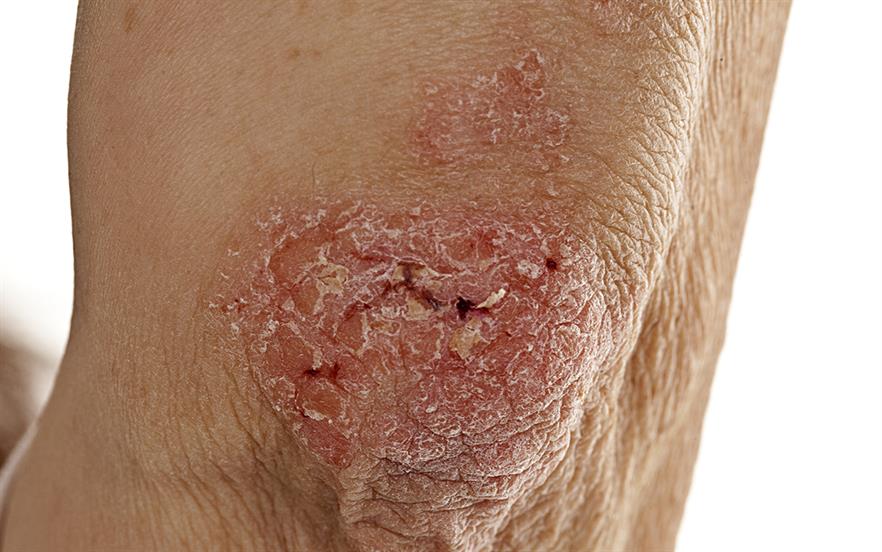 plaque psoriasis nhs)