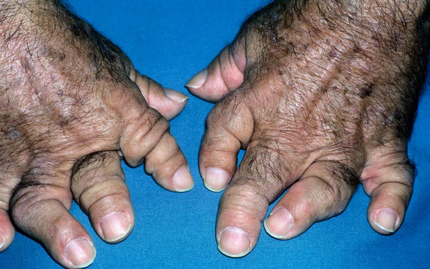 Oral Psoriatic Arthritis Treatment Accepted For NHS Use | MIMS Online