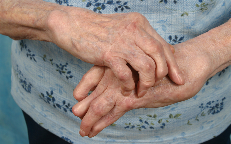 Tofacitinib reduces inflammation in patients with rheumatoid arthritis. | iStock