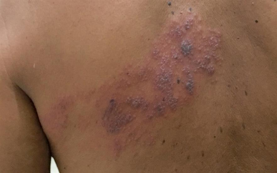 New Shingles Vaccine Awaits Decision On Nhs Use Mims Online