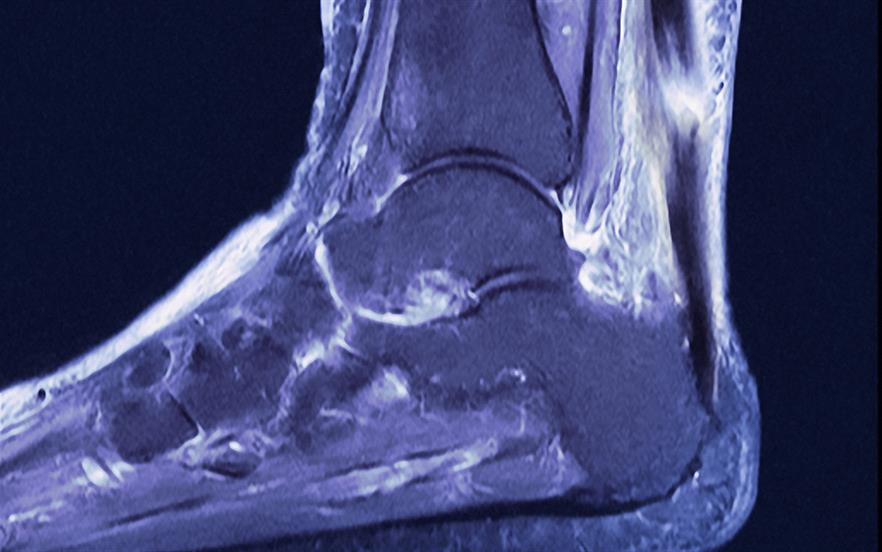Tendon damage (especially to the Achilles tendon but also other tendons) can occur within 48 hours of starting quinolone treatment. | GUSTOIMAGES/SCIENCE PHOTO LIBRARY