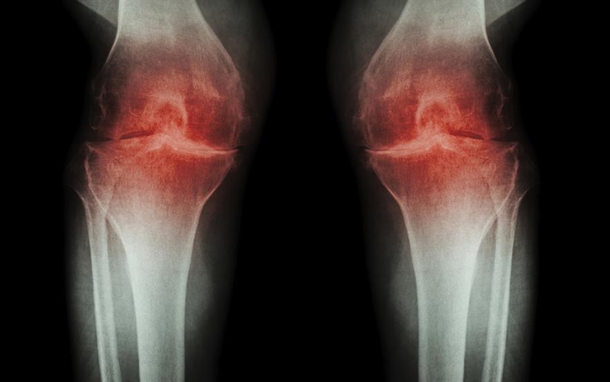 Bisphosphonates are used to treat osteoporosis, Paget’s disease, and as part of some cancer regimens. | iStock