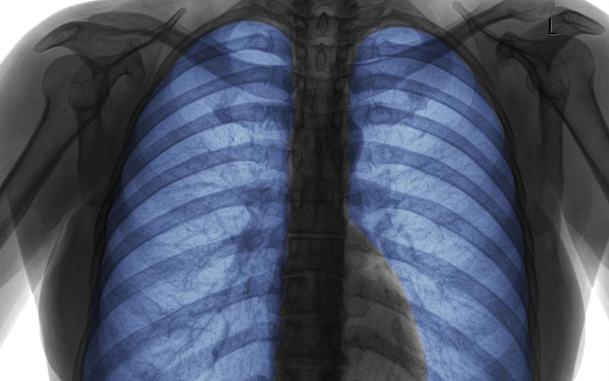 Fostair (formoterol/beclometasone) delivers extrafine particles into the lungs, allowing a lower daily dose of corticosteroid to be given. | iStock