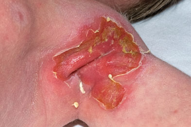 Erosive SSSS in a neonate may require more aggressive therapy (Photograph: King's College Hospital)