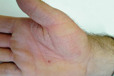 The patient reported intense itching and rash on both palms (Photograph: Dr Suneeta Kochhar)