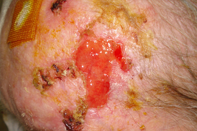 This florid case resolved with the use of a very potent topical steroid (Photograph: Dr Brian Malcolm)