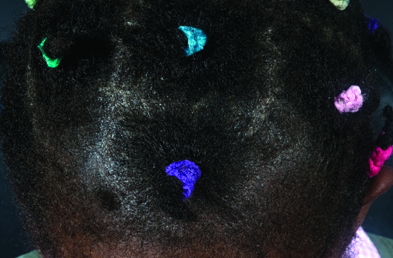 Scaling of the scalp in a young child should raise the clinical suspicion of tinea capitis (Photograph: King’s College Hospital Dermatology Dept)