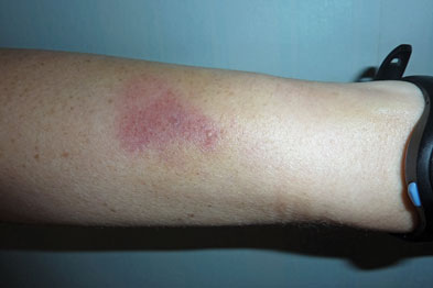 Medical Education: Cutaneous reaction to docetaxel | MIMS online