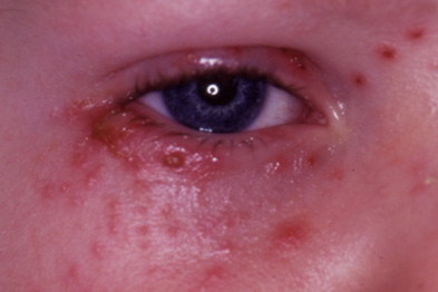 Diagnosis of facial ulcers in children | MIMS online