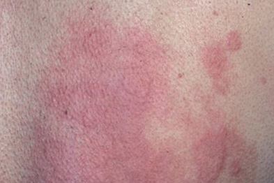 Chronic urticaria can respond to methotrexate