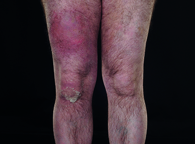 Cellulitis on right thigh, secondary to IM injection (Photograph: Dept Medical Illustration, Norfolk & Norwich University Hospital)