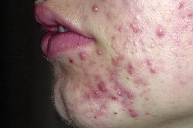 Adolescents with severe acne can experience depression (Photograph: Dr Nigel Stollery)