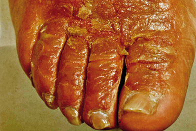 Contact dermatitis with secondary infection due to staph aureus