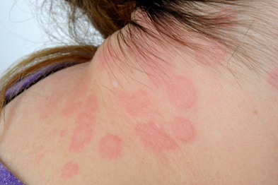 Chronic urticaria can have a significant impact on quality of life (Photograph: Science Photo Library)