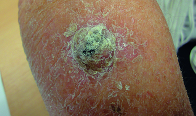 SCC: crusted skin lesion that had recently increased in size (Photograph: Dr Suneeta Kochhar)
