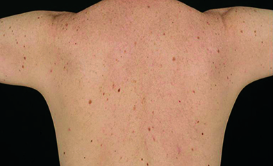 Atypical mole syndrome increases the risk of melanoma (Photograph: Professor Rino Cerio/Royal London Hospital)