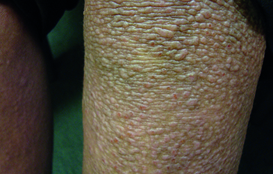 Atopic eczema and lichenoid papules (Photograph: Dr Ekaterina Burova)