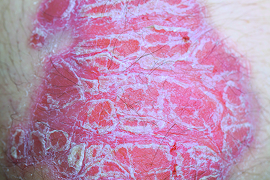 Plaque psoriasis: new treatment for patients with severe disease (Photograph: iStock)