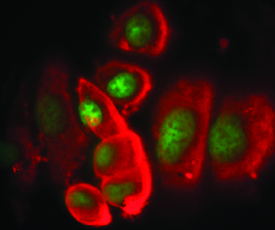 Fluorescence microscopy showing REDantibody image of breast cancer cells (Photograph: Angray S Kang, Anatoliy Markiv)