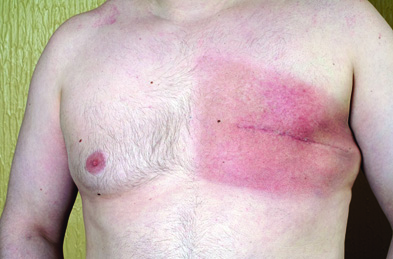 Men with breast cancer tend to present later and have a worse prognosis than women (Photograph: Maria Platt-Evans/SPL)