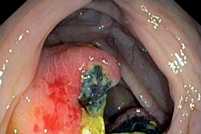 Endoscopic view showing adenocarcinoma of the caecum