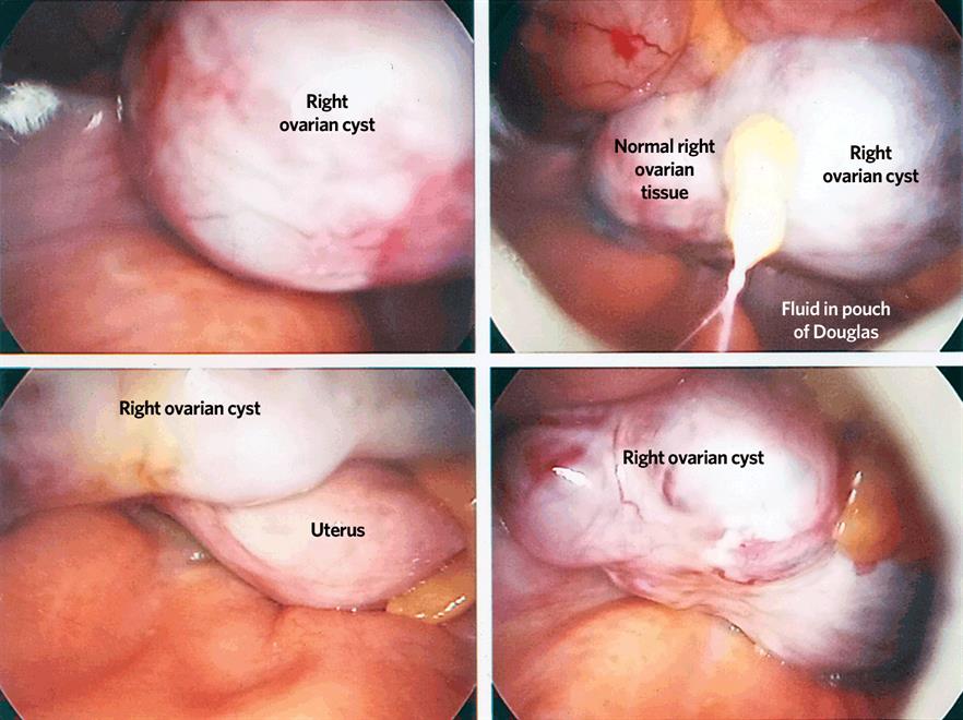 Right ovarian cyst in a 61-year-old patient (Photograph: Brighton and Sussex University Hospitals NHS Trust)