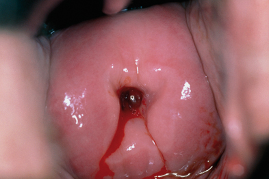 Colposcopy showing severely dysplastic cervix (CIN3)