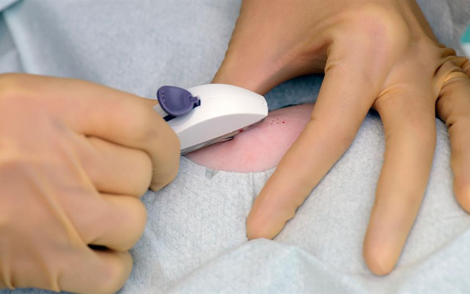 Nexplanon: rare reports of implant migration