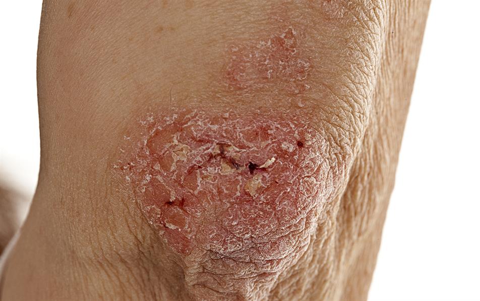 NHS approval for latest psoriasis biologic MIMS online