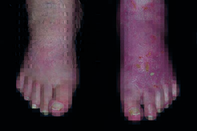 Fungal Infection Image & Photo (Free Trial)