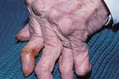 artrita reumatoida deformanta