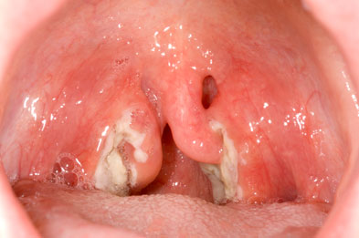 Repeated purulent tonsillitis with fever