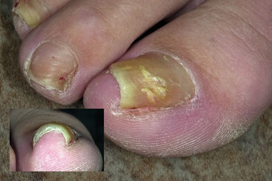 Clinical images: nails | GPonline
