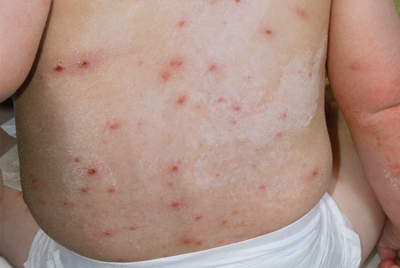 Chickenpox varicella Zoster Clinical Review GPonline