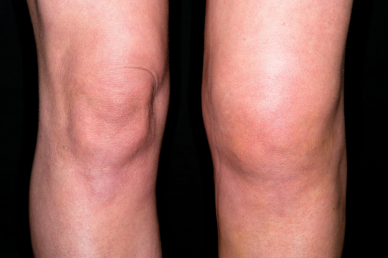 Management Of Acl Rupture Gponline 