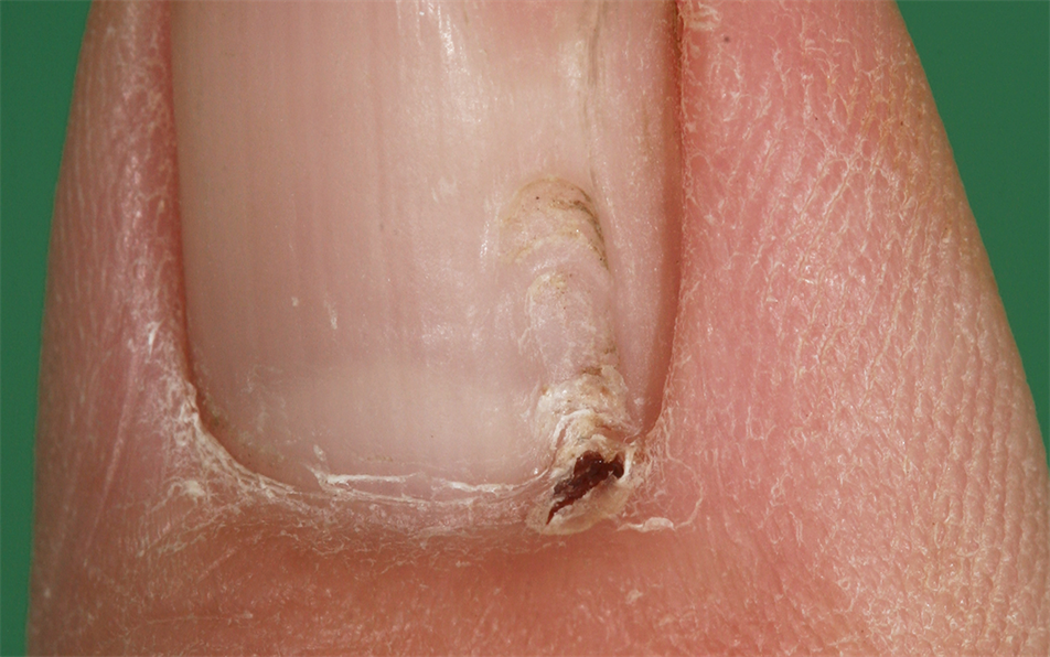 When melanoma hides Woman develops skin cancer under her nail  National   Globalnewsca