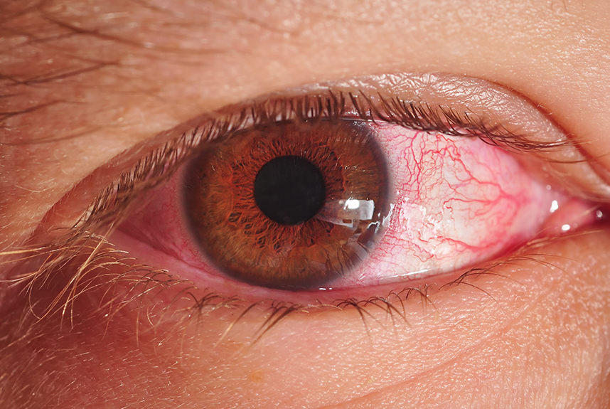 Eye - red flag symptoms | GPonline