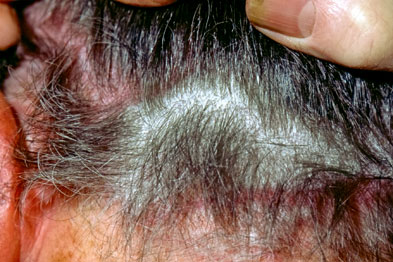 Diagnosing scalp conditions | GPonline