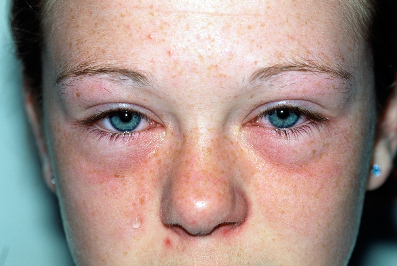 Case study: Hayfever in an adolescent | GPonline